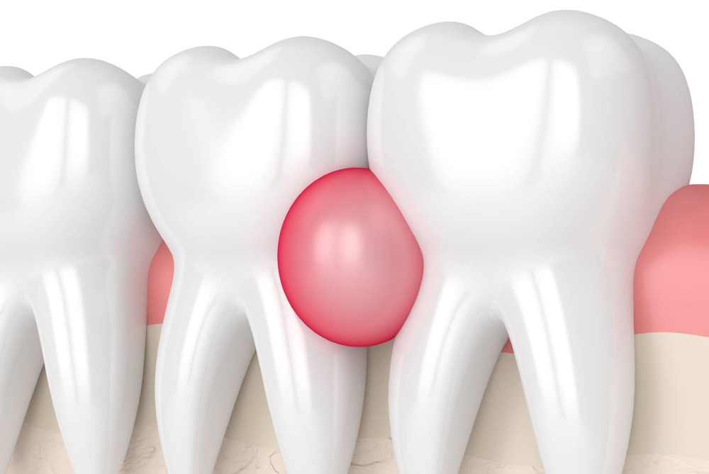 ماساژ لثه و دندان با روغن طبیعی